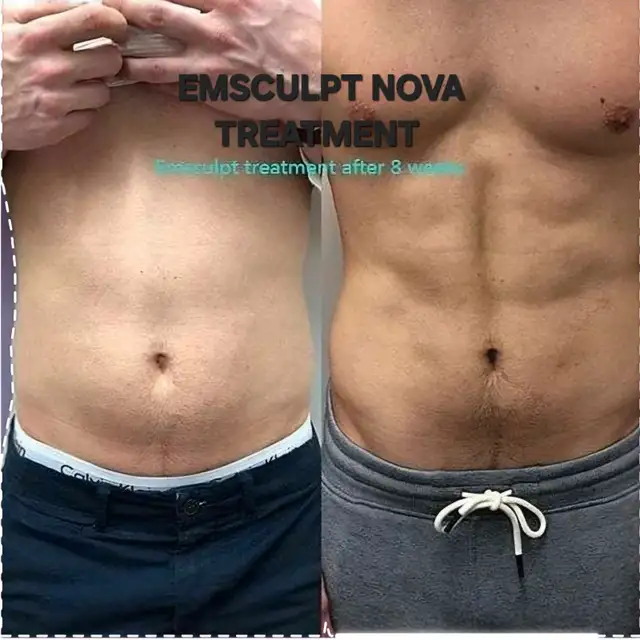 $100 EMSCULPT TREATMENT FOR SUMMER TIME TONED BODY 62863723457409123