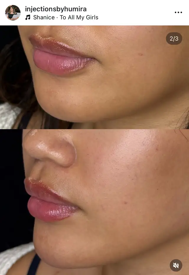 Botox- filler 64519987427713123