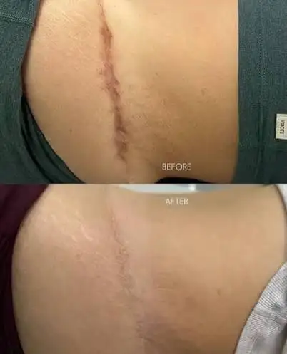 FREE MODEL WANTED - Scar & Stretch Mark Camouflage