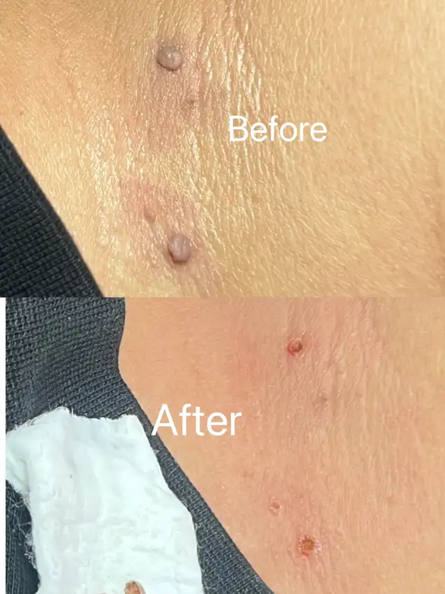 Skin Tag Removal from $10+ | Laser Hair Removal 50% OFF 