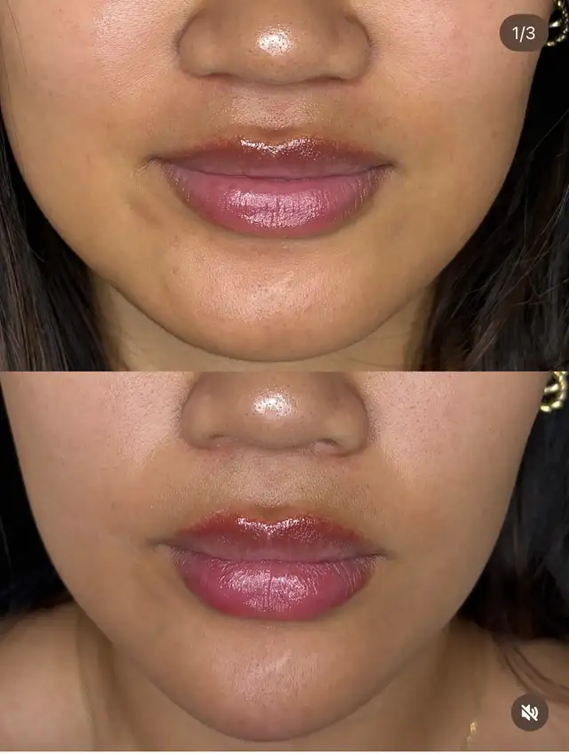 Botox- filler 64519987427713124