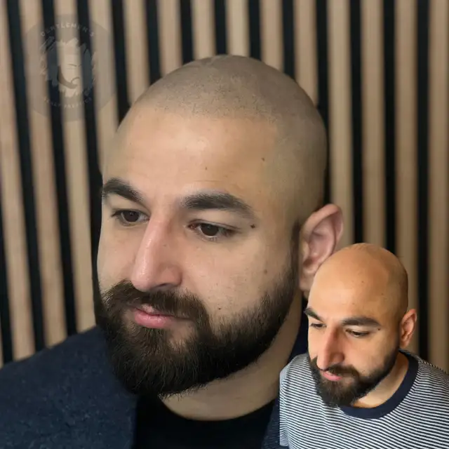 Scalp Micropigmentation | SMP | Hair & Scalp Tattoo | Hairline628632380472341210