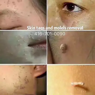 Skin tags removal 50% off, View more