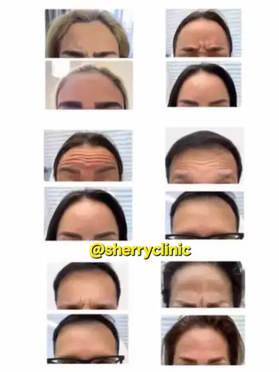 November Botox Deals & Fillers Specials Toronto, View more