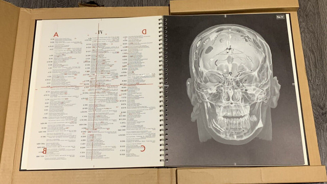 NEW Vintage Radiographic Atlas of the Human Skull First edition in Textbooks in Markham / York Region - Image 4