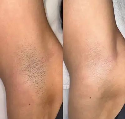 Calgary Full Body Laser Hair Removal – $200  (Men & Women), View more