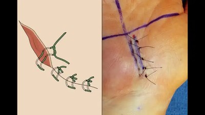 WOUNDCARE MANAGEMENT, PHLEBOTOMY, SUTURE TECHNIQUE- Programs, View more