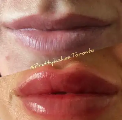 ‼️ PROMO Lips/Nose FILLERS ON YONGE-EGLINTON ‼️, View more
